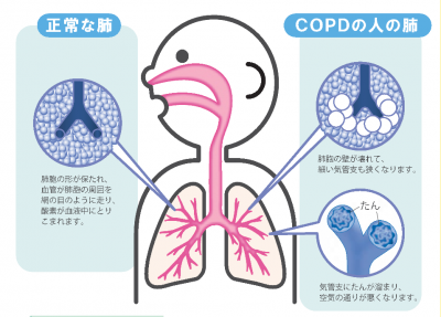 健康な肺とCOPDの人の肺の絵